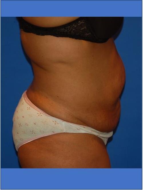 Tummy Tuck Before Photo | Phoenix and Scottsdale, AZ | Scottsdale Center for Plastic Surgery