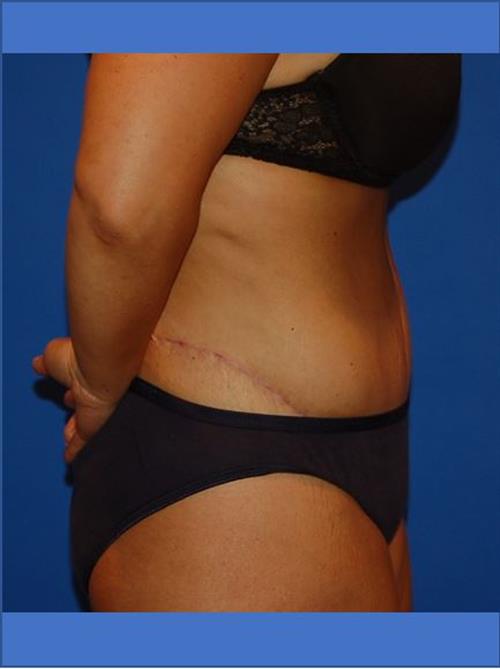 Tummy Tuck After Photo | Phoenix and Scottsdale, AZ | Scottsdale Center for Plastic Surgery
