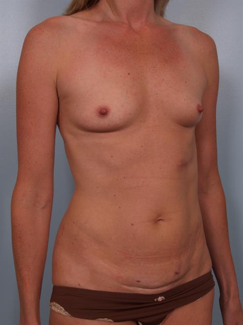 Breast Augmentation Before Photo | Phoenix and Scottsdale, AZ | Scottsdale Center for Plastic Surgery