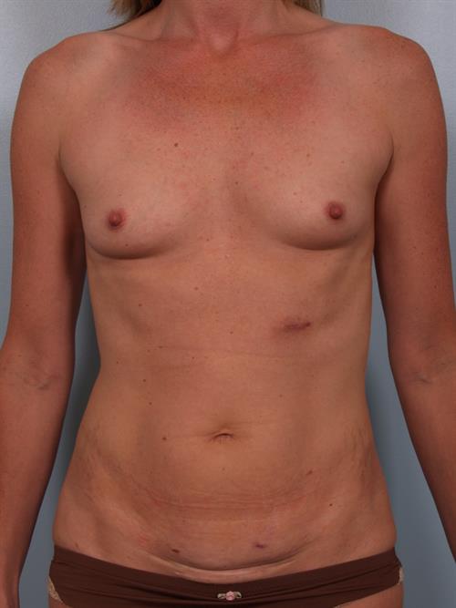 Breast Augmentation Before Photo | Phoenix and Scottsdale, AZ | Scottsdale Center for Plastic Surgery