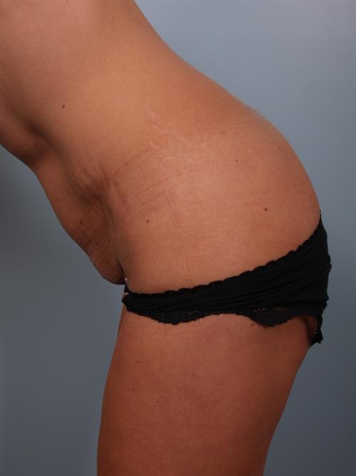 Breast Augmentation Before Photo | Phoenix and Scottsdale, AZ | Scottsdale Center for Plastic Surgery