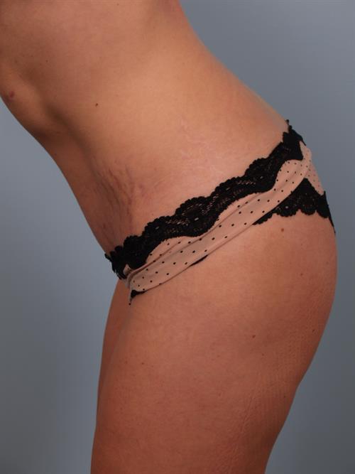 Breast Augmentation After Photo | Phoenix and Scottsdale, AZ | Scottsdale Center for Plastic Surgery