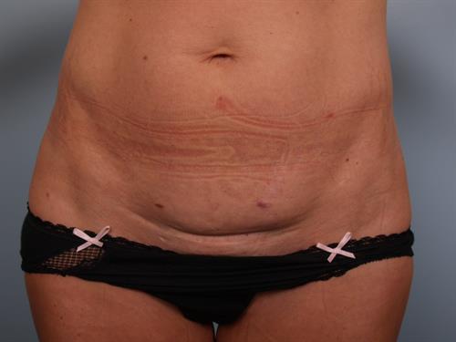 Breast Augmentation Before Photo | Phoenix and Scottsdale, AZ | Scottsdale Center for Plastic Surgery