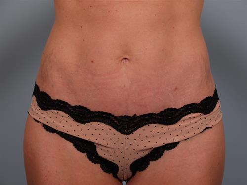 Breast Augmentation After Photo | Phoenix and Scottsdale, AZ | Scottsdale Center for Plastic Surgery