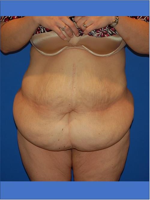 Power Assisted Liposuction Before Photo | Phoenix and Scottsdale, AZ | Scottsdale Center for Plastic Surgery