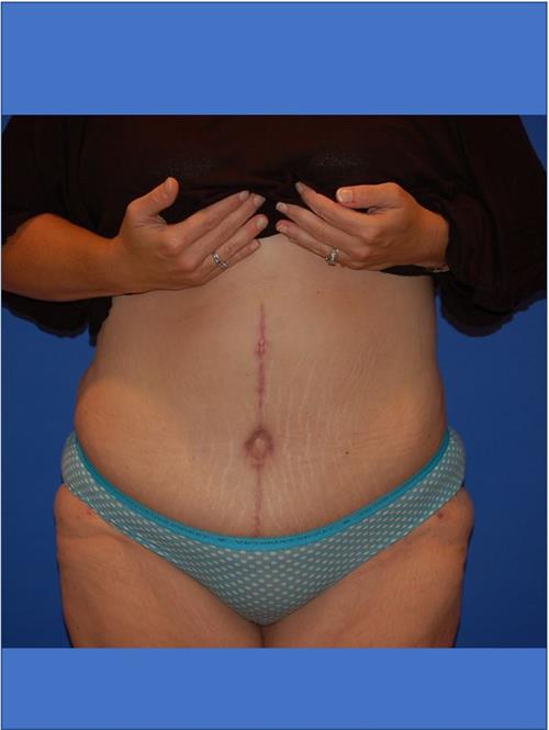 Power Assisted Liposuction After Photo | Phoenix and Scottsdale, AZ | Scottsdale Center for Plastic Surgery
