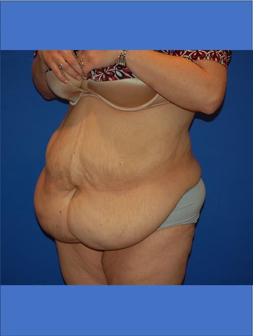 Power Assisted Liposuction Before Photo | Phoenix and Scottsdale, AZ | Scottsdale Center for Plastic Surgery