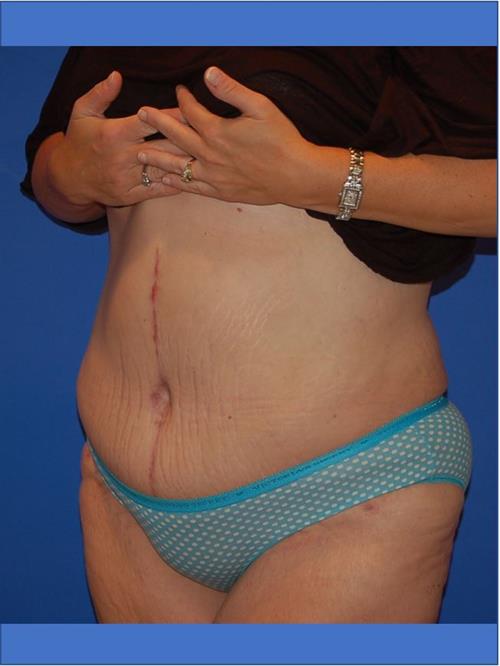 Power Assisted Liposuction After Photo | Phoenix and Scottsdale, AZ | Scottsdale Center for Plastic Surgery