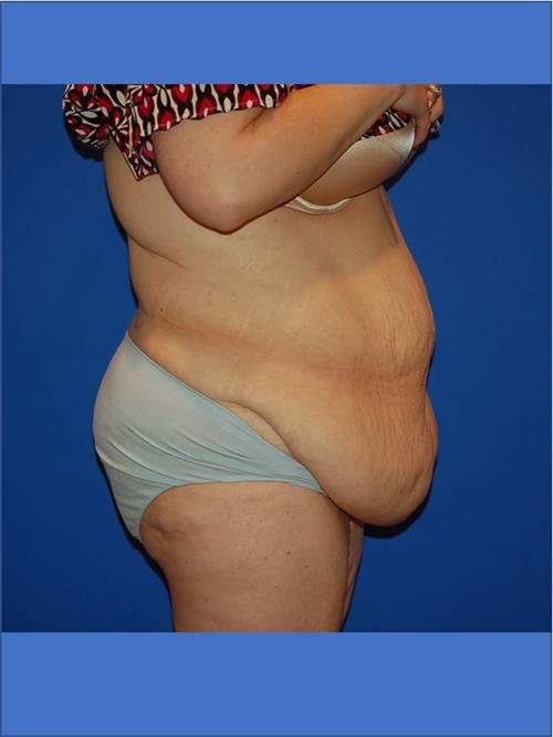 Power Assisted Liposuction Before Photo | Phoenix and Scottsdale, AZ | Scottsdale Center for Plastic Surgery