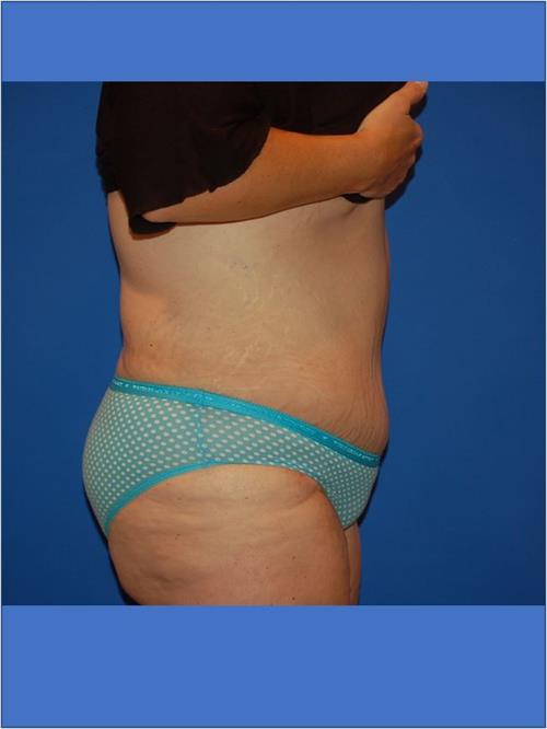 Power Assisted Liposuction After Photo | Phoenix and Scottsdale, AZ | Scottsdale Center for Plastic Surgery