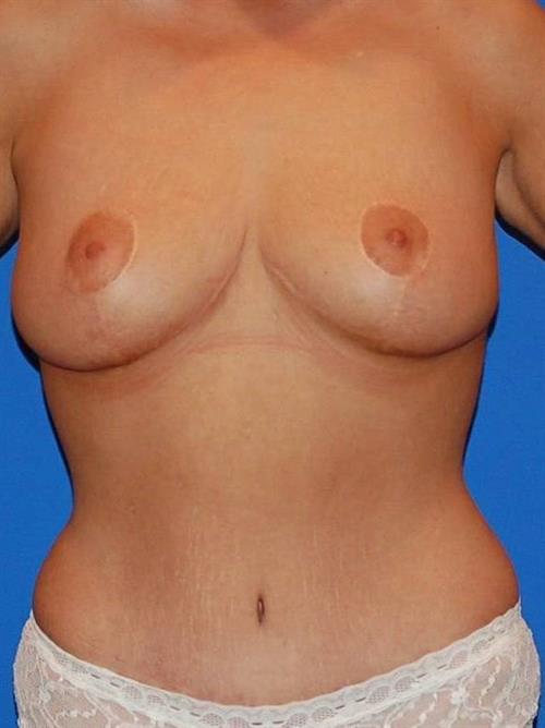 Breast Lift (Mastopexy) After Photo | Phoenix and Scottsdale, AZ | Scottsdale Center for Plastic Surgery