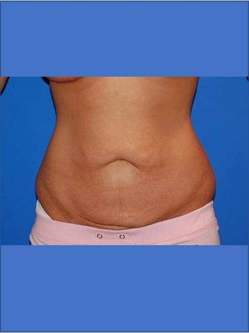 Tummy Tuck Before Photo | Phoenix and Scottsdale, AZ | Scottsdale Center for Plastic Surgery
