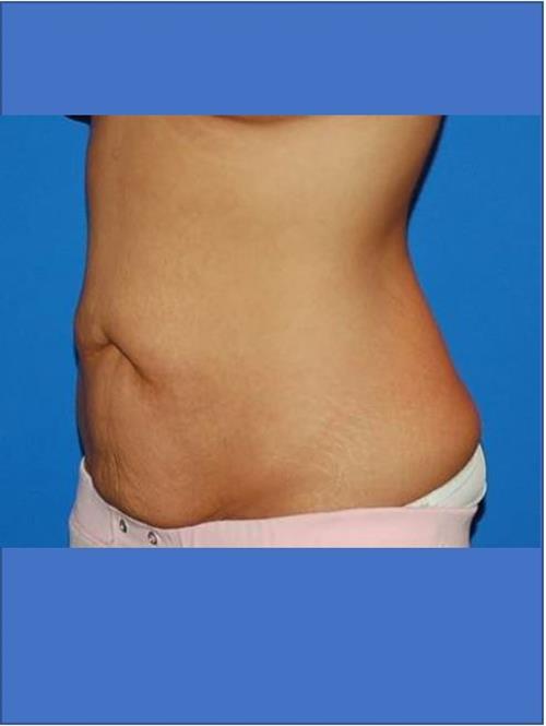 Tummy Tuck Before Photo | Phoenix and Scottsdale, AZ | Scottsdale Center for Plastic Surgery