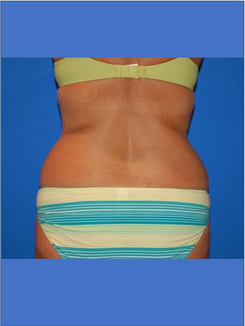 Power Assisted Liposuction Before Photo | Phoenix and Scottsdale, AZ | Scottsdale Center for Plastic Surgery