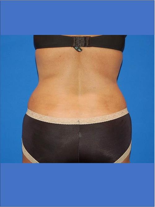Power Assisted Liposuction After Photo | Phoenix and Scottsdale, AZ | Scottsdale Center for Plastic Surgery