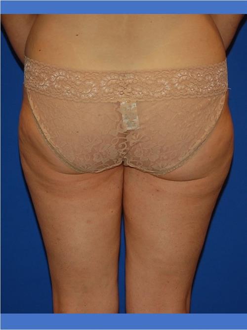 Power Assisted Liposuction Before Photo | Phoenix and Scottsdale, AZ | Scottsdale Center for Plastic Surgery