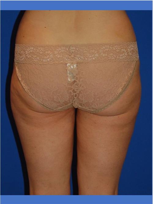 Power Assisted Liposuction After Photo | Phoenix and Scottsdale, AZ | Scottsdale Center for Plastic Surgery