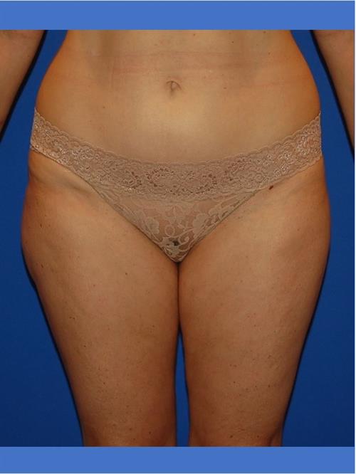 Power Assisted Liposuction Before Photo | Phoenix and Scottsdale, AZ | Scottsdale Center for Plastic Surgery