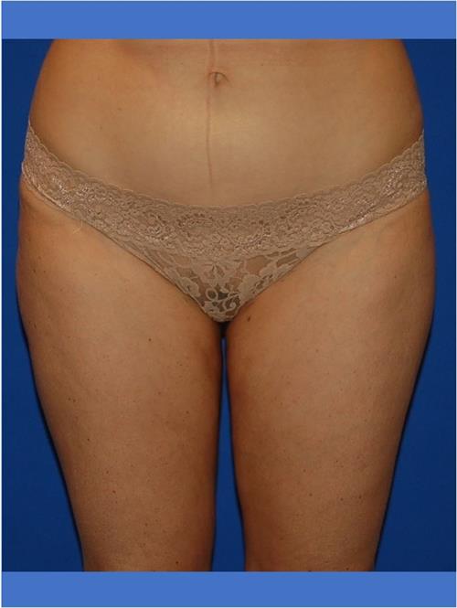 Power Assisted Liposuction After Photo | Phoenix and Scottsdale, AZ | Scottsdale Center for Plastic Surgery