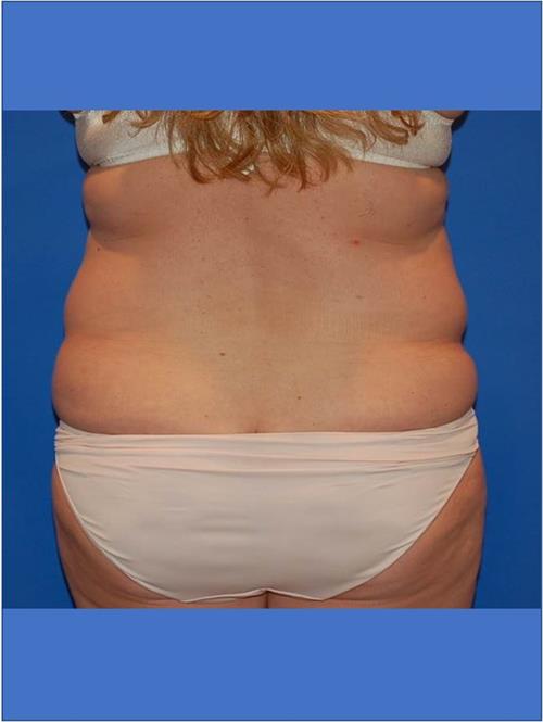 Power Assisted Liposuction Before Photo | Phoenix and Scottsdale, AZ | Scottsdale Center for Plastic Surgery