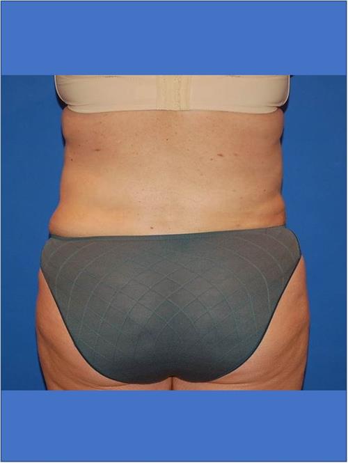 Power Assisted Liposuction After Photo | Phoenix and Scottsdale, AZ | Scottsdale Center for Plastic Surgery