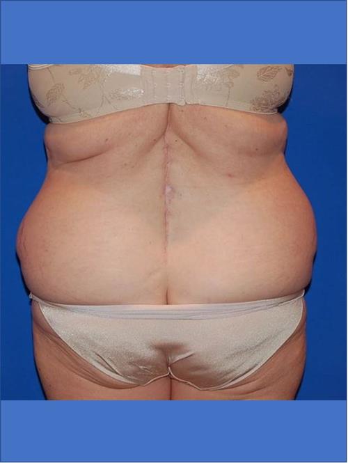 Power Assisted Liposuction Before Photo | Phoenix and Scottsdale, AZ | Scottsdale Center for Plastic Surgery