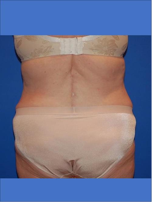 Power Assisted Liposuction After Photo | Phoenix and Scottsdale, AZ | Scottsdale Center for Plastic Surgery
