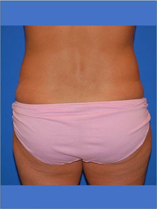 Power Assisted Liposuction Before Photo | Phoenix and Scottsdale, AZ | Scottsdale Center for Plastic Surgery