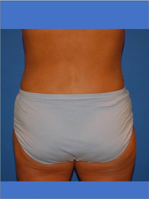 Power Assisted Liposuction After Photo | Phoenix and Scottsdale, AZ | Scottsdale Center for Plastic Surgery