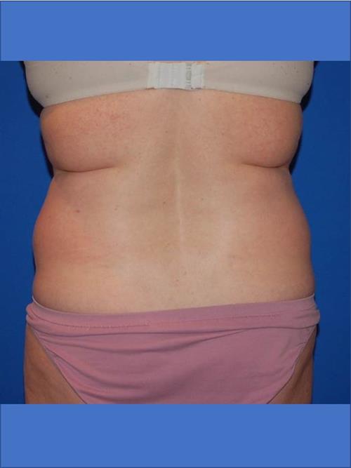Power Assisted Liposuction Before Photo | Phoenix and Scottsdale, AZ | Scottsdale Center for Plastic Surgery