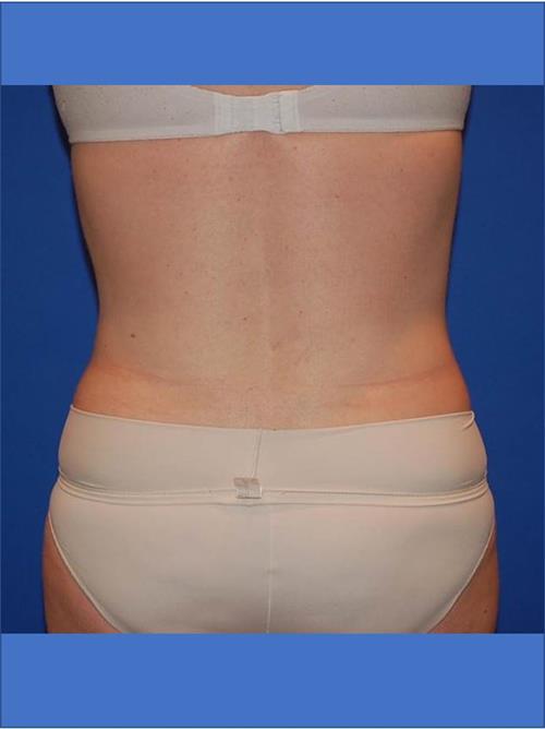 Power Assisted Liposuction After Photo | Phoenix and Scottsdale, AZ | Scottsdale Center for Plastic Surgery