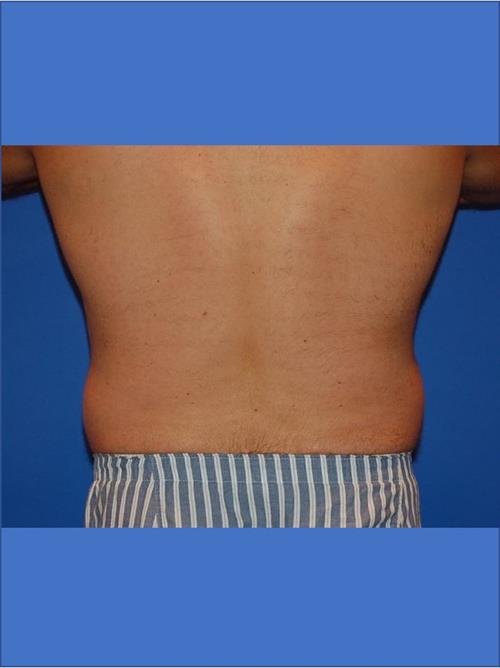 Male Liposuction Before Photo | Phoenix and Scottsdale, AZ | Scottsdale Center for Plastic Surgery