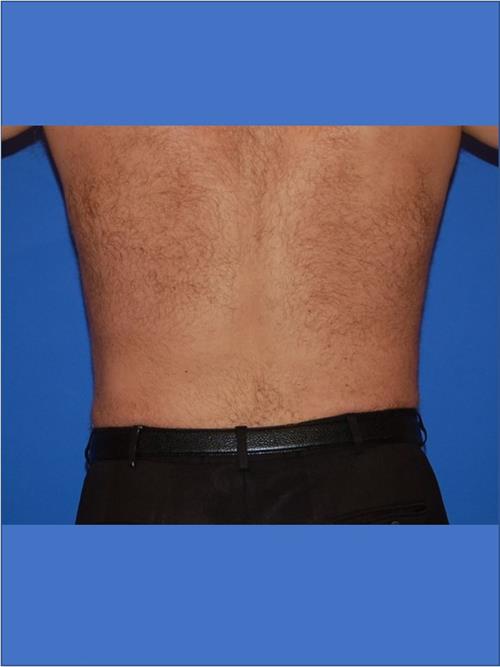 Male Liposuction After Photo | Phoenix and Scottsdale, AZ | Scottsdale Center for Plastic Surgery