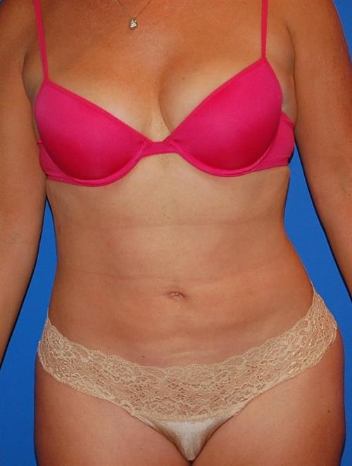 Power Assisted Liposuction After Photo | Phoenix and Scottsdale, AZ | Scottsdale Center for Plastic Surgery
