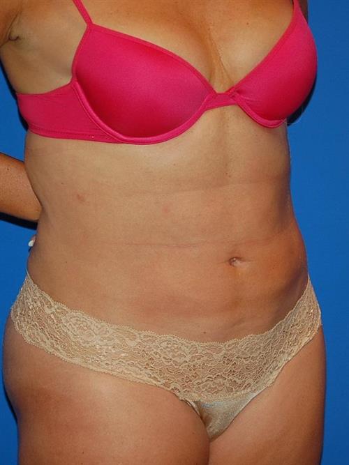 Power Assisted Liposuction After Photo | Phoenix and Scottsdale, AZ | Scottsdale Center for Plastic Surgery