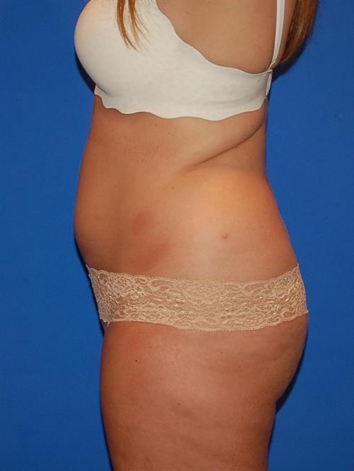 Power Assisted Liposuction Before Photo | Phoenix and Scottsdale, AZ | Scottsdale Center for Plastic Surgery