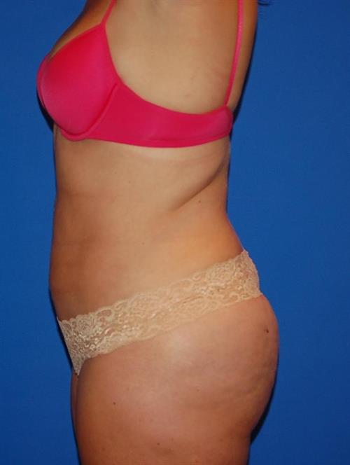 Power Assisted Liposuction After Photo | Phoenix and Scottsdale, AZ | Scottsdale Center for Plastic Surgery