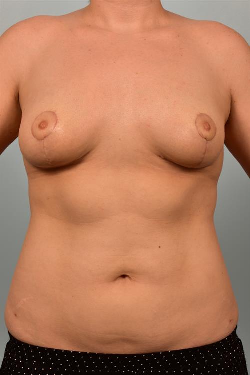Fat Grafting After Photo | Phoenix and Scottsdale, AZ | Scottsdale Center for Plastic Surgery