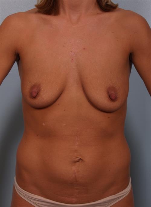 Breast Augmentation Before Photo | Phoenix and Scottsdale, AZ | Scottsdale Center for Plastic Surgery