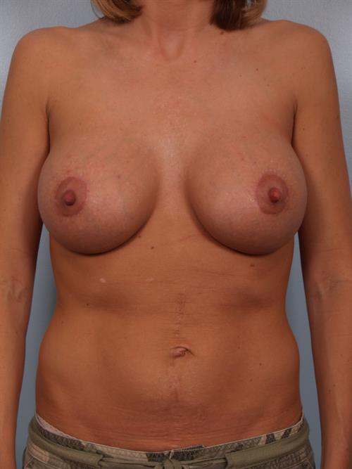 Breast Augmentation After Photo | Phoenix and Scottsdale, AZ | Scottsdale Center for Plastic Surgery