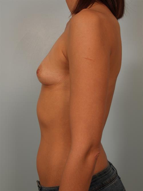 Breast Augmentation Before Photo | Phoenix and Scottsdale, AZ | Scottsdale Center for Plastic Surgery