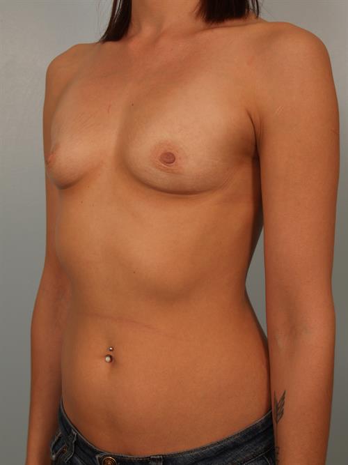 Breast Augmentation Before Photo | Phoenix and Scottsdale, AZ | Scottsdale Center for Plastic Surgery