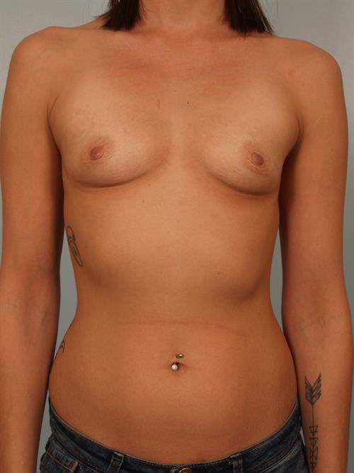 Breast Augmentation Before Photo | Phoenix and Scottsdale, AZ | Scottsdale Center for Plastic Surgery