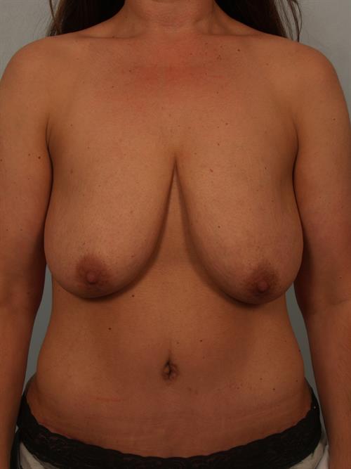 Revision Breast Surgery Before Photo | Phoenix and Scottsdale, AZ | Scottsdale Center for Plastic Surgery