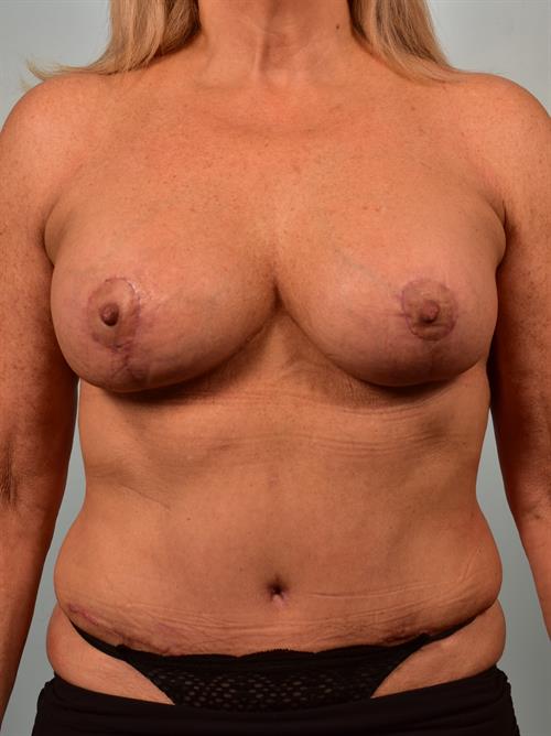 Sub-Fascial Breast Augmentation After Photo | Phoenix and Scottsdale, AZ | Scottsdale Center for Plastic Surgery