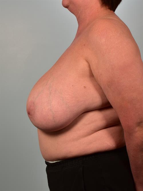 Breast Lift (Mastopexy) Before Photo | Phoenix and Scottsdale, AZ | Scottsdale Center for Plastic Surgery