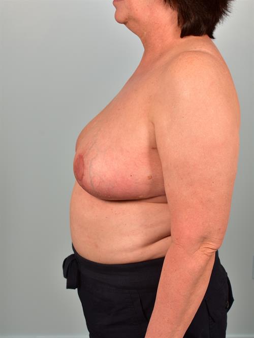 Breast Lift (Mastopexy) After Photo | Phoenix and Scottsdale, AZ | Scottsdale Center for Plastic Surgery