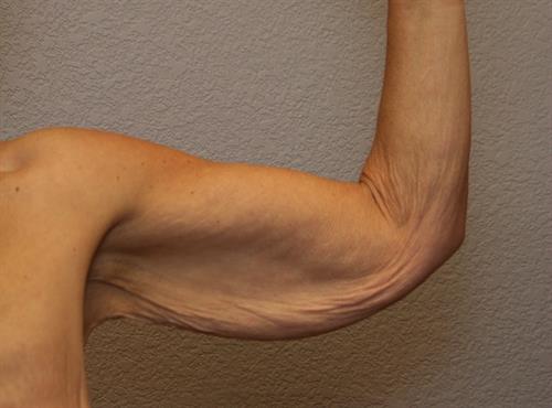 Brachioplasty (Arm Lift) Before Photo | Phoenix and Scottsdale, AZ | Scottsdale Center for Plastic Surgery