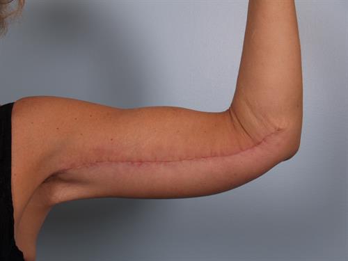 Brachioplasty (Arm Lift) After Photo | Phoenix and Scottsdale, AZ | Scottsdale Center for Plastic Surgery
