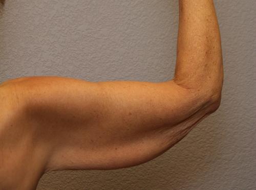Brachioplasty (Arm Lift) Before Photo | Phoenix and Scottsdale, AZ | Scottsdale Center for Plastic Surgery